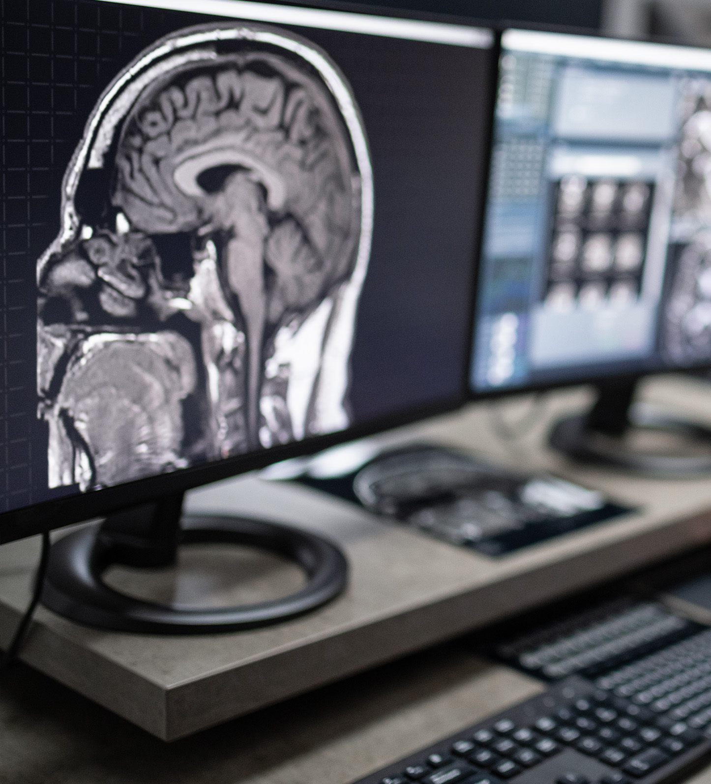 MRI of a head on a computer screen